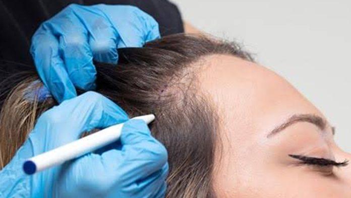 FUE Hair Transplant